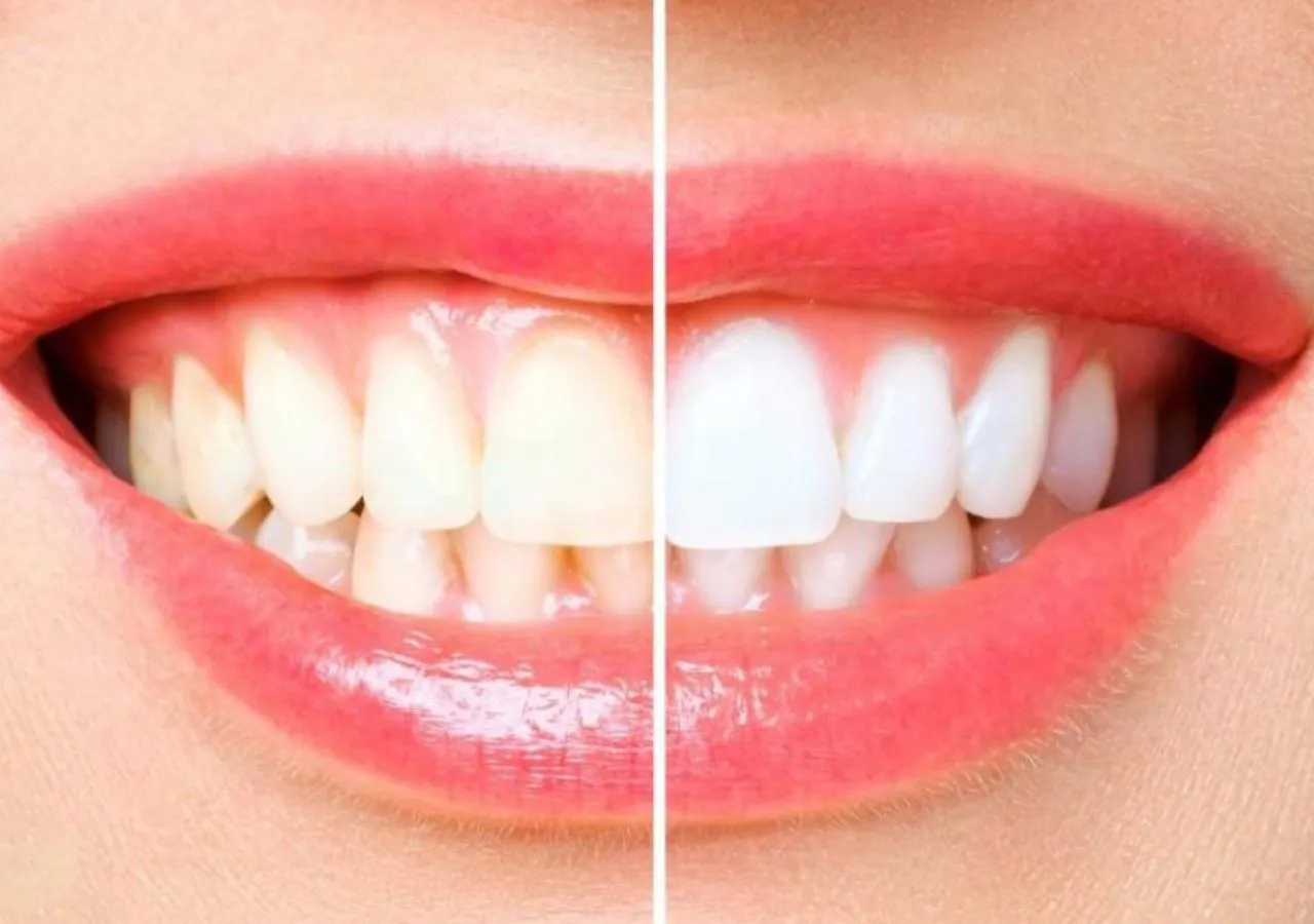 Blanqueamiento Dental